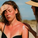 Žena s popálenou pokožkou na pláži, dostáva pomoc od priateľky.